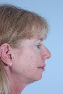 Facelift Before Photo by Scott Spear, MD, FACS; Chevy Chase, MD - Case 7099