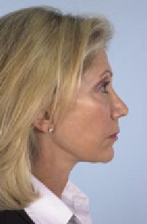 Facelift After Photo by Scott Spear, MD, FACS; Chevy Chase, MD - Case 7100