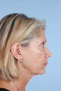 Facelift Before Photo by Scott Spear, MD, FACS; Chevy Chase, MD - Case 7100