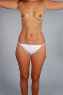 Liposuction Before Photo by Scott Spear, MD, FACS; Chevy Chase, MD - Case 7294