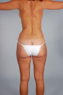 Liposuction After Photo by Scott Spear, MD, FACS; Chevy Chase, MD - Case 7294