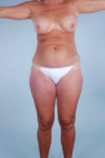 Liposuction Before Photo by Scott Spear, MD, FACS; Chevy Chase, MD - Case 7296