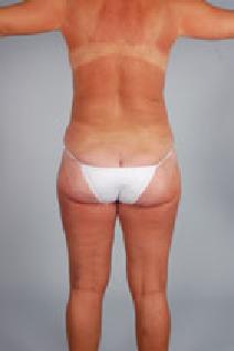 Liposuction After Photo by Scott Spear, MD, FACS; Chevy Chase, MD - Case 7296