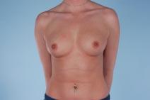 Breast Augmentation Before Photo by Scott Spear, MD, FACS; Chevy Chase, MD - Case 7305