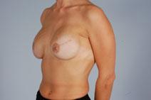 Breast Reconstruction After Photo by Scott Spear, MD, FACS; Chevy Chase, MD - Case 7327