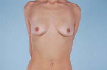 Breast Reconstruction Before Photo by Scott Spear, MD, FACS; Chevy Chase, MD - Case 8072