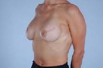 Breast Reconstruction After Photo by Scott Spear, MD, FACS; Chevy Chase, MD - Case 8072