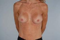 Breast Augmentation After Photo by Scott Spear, MD, FACS; Chevy Chase, MD - Case 9035
