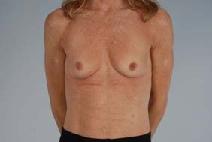 Breast Augmentation Before Photo by Scott Spear, MD, FACS; Chevy Chase, MD - Case 9035