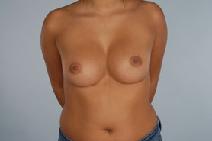 Breast Augmentation After Photo by Scott Spear, MD, FACS; Chevy Chase, MD - Case 9737