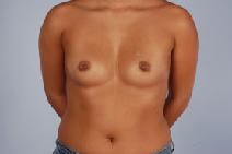 Breast Augmentation Before Photo by Scott Spear, MD, FACS; Chevy Chase, MD - Case 9737