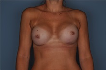 Breast Augmentation After Photo by Nathan Patterson, MD; Pensacola, FL - Case 35323