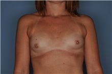 Breast Augmentation Before Photo by Nathan Patterson, MD; Pensacola, FL - Case 35323