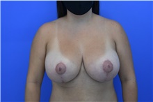 Breast Augmentation After Photo by Sanjay Sharma, MD, FACS; Austin, TX - Case 47889