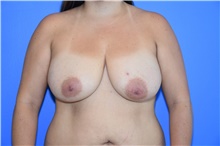 Breast Augmentation Before Photo by Sanjay Sharma, MD, FACS; Austin, TX - Case 47889