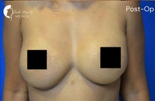 Breast Reconstruction After Photo by Sarah Hagarty, MD; ,  - Case 50329