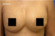 Breast Reconstruction Before Photo by Sarah Hagarty, MD; ,  - Case 50329