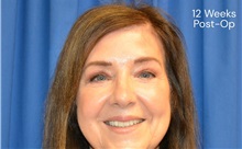 Eyelid Surgery After Photo by Sarah Hagarty, MD; ,  - Case 50328