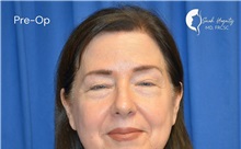 Eyelid Surgery Before Photo by Sarah Hagarty, MD; ,  - Case 50328