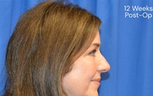 Eyelid Surgery After Photo by Sarah Hagarty, MD; ,  - Case 50328