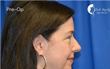 Eyelid Surgery Before Photo by Sarah Hagarty, MD; ,  - Case 50328