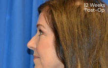 Eyelid Surgery After Photo by Sarah Hagarty, MD; ,  - Case 50328