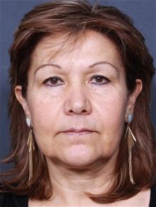 Facelift Before Photo by Johan Brahme, MD; La Jolla, CA - Case 25634