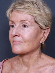 Facelift After Photo by Johan Brahme, MD; La Jolla, CA - Case 25639