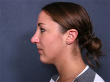 Rhinoplasty After Photo by Johan Brahme, MD; La Jolla, CA - Case 25707