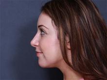 Rhinoplasty After Photo by Johan Brahme, MD; La Jolla, CA - Case 25708