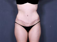 Tummy Tuck After Photo by Johan Brahme, MD; La Jolla, CA - Case 25746