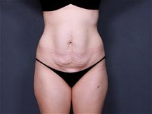 Tummy Tuck Before Photo by Johan Brahme, MD; La Jolla, CA - Case 25746