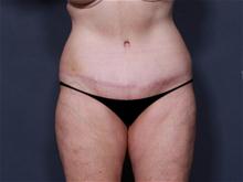 Tummy Tuck After Photo by Johan Brahme, MD; La Jolla, CA - Case 25747