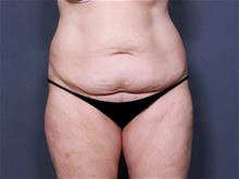 Tummy Tuck Before Photo by Johan Brahme, MD; La Jolla, CA - Case 25747