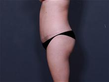 Tummy Tuck After Photo by Johan Brahme, MD; La Jolla, CA - Case 25748