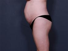 Tummy Tuck Before Photo by Johan Brahme, MD; La Jolla, CA - Case 25748