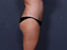 Tummy Tuck After Photo by Johan Brahme, MD; La Jolla, CA - Case 25750
