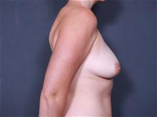 Breast Lift Before Photo by Johan Brahme, MD; La Jolla, CA - Case 25754