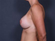 Breast Lift After Photo by Johan Brahme, MD; La Jolla, CA - Case 25758