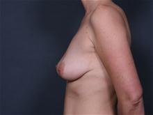 Breast Lift Before Photo by Johan Brahme, MD; La Jolla, CA - Case 25758