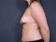 Breast Lift Before Photo by Johan Brahme, MD; La Jolla, CA - Case 25759