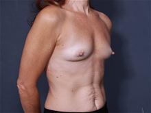 Breast Augmentation Before Photo by Johan Brahme, MD; La Jolla, CA - Case 25827
