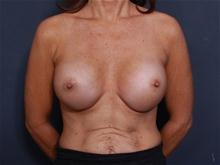 Breast Augmentation After Photo by Johan Brahme, MD; La Jolla, CA - Case 25827