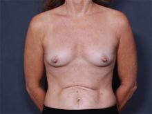 Breast Augmentation Before Photo by Johan Brahme, MD; La Jolla, CA - Case 25827