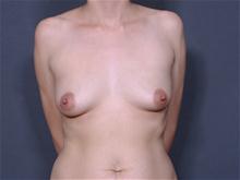 Breast Lift Before Photo by Johan Brahme, MD; La Jolla, CA - Case 25840
