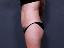 Tummy Tuck Before Photo by Johan Brahme, MD; La Jolla, CA - Case 26035