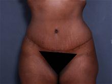Tummy Tuck After Photo by Johan Brahme, MD; La Jolla, CA - Case 27606