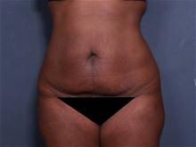 Tummy Tuck Before Photo by Johan Brahme, MD; La Jolla, CA - Case 27606