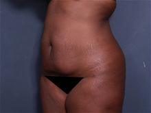 Tummy Tuck Before Photo by Johan Brahme, MD; La Jolla, CA - Case 27606