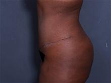 Tummy Tuck After Photo by Johan Brahme, MD; La Jolla, CA - Case 27606
